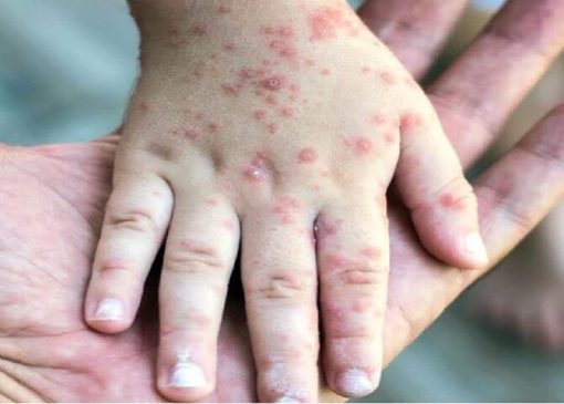 ثبت ۷۱۴ مورد «سرخک» در کشور؛ اوج ابتلا در اردیبهشت