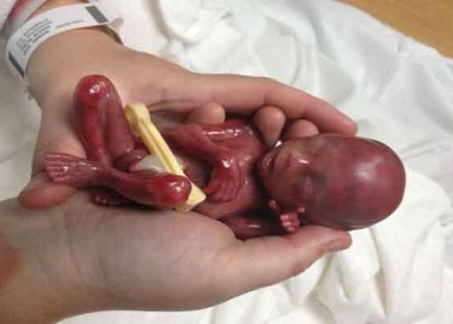 سقط جنین؛ از «صنعت پول‌های سیاه» تا عوارض جبران‌ناپذیر جسمی و روانی