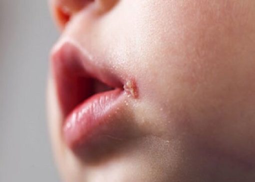 تفاوت آفت و تبخال در کودکان