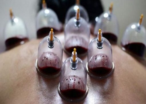 حجامت توسط افراد غیر متخصص خطرناک است