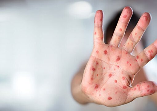 موج سرخک در بنگلادش جان ۵۰۰ کودک را گرفت